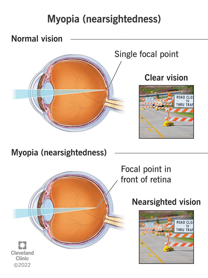 myopia-nearsightedness.jpg