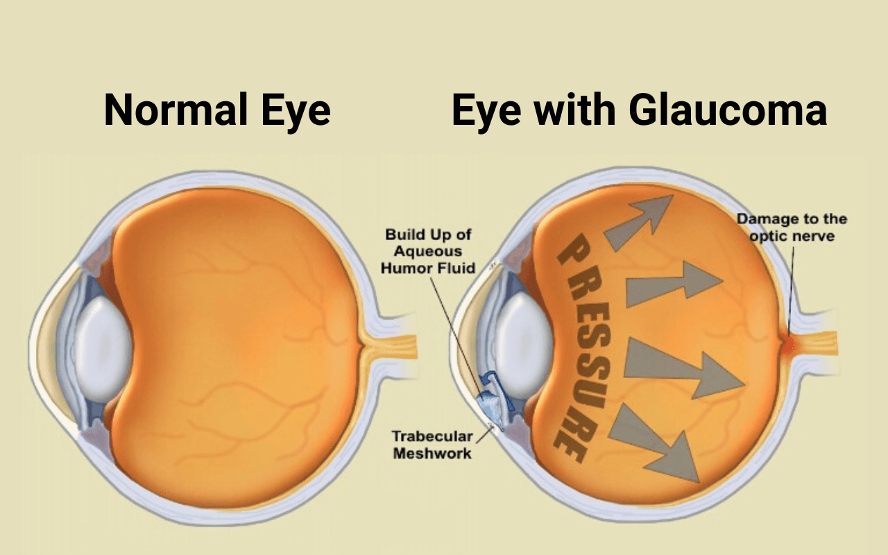 glaucoma 2 eyes.png